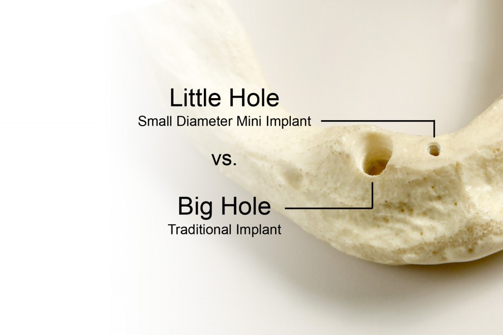 Mini Dental Implant vs. Traditional Implant